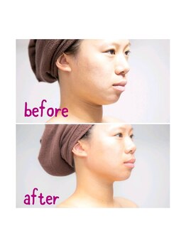 サットサンガ 表参道(SatSangah)/小顔コース 60分/before after