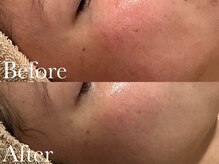 シェリーミル(Cherie Miru)/赤みケア/乾燥/開き毛穴/保湿