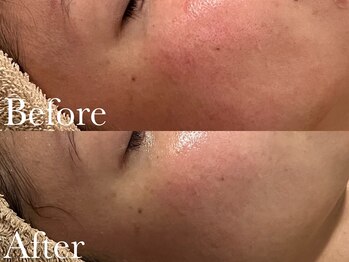 シェリーミル(Cherie Miru)/赤みケア/乾燥/開き毛穴/保湿