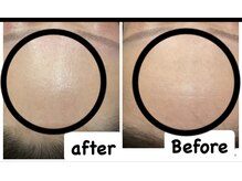 サロンドビジュー(salon de bijou)/ハーブピーリング×フルケアsp