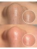 PR用｜毛穴にお悩みの方｜毛穴洗浄｜毛穴