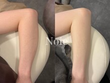 ノイエ(NOIE)/ハーブピーリング肌質改善　Noie