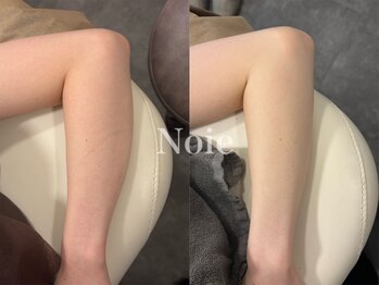 ノイエ(NOIE)/ハーブピーリング肌質改善 Noie