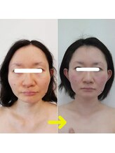 ハート 大分(heart)/インディバ最強フェイシャル