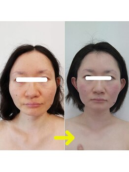 ハート 大分(heart)/インディバ最強フェイシャル