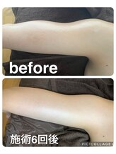 ギンザアール(GINZA R.)/ブライダルエステに♪