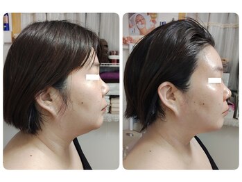 ティアス(t-us)/【小顔・痩身】脂肪分解