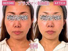 べモーレ 上本町 谷町九丁目(Bemolle)/40代プラズマ×幹細胞1回☆