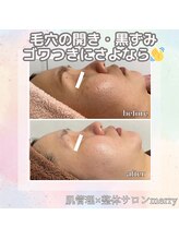メリー 大和西大寺店(merry)/毛穴開き、黒ずみも綺麗に★
