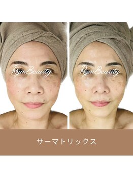 リム ビューティー(RYM BEAUTY)/サーマトリックス