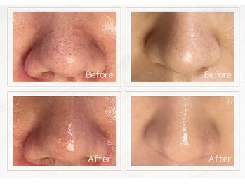 セレーノ 横浜(seReno)/潤艶ワックス 鼻のビフォアフ