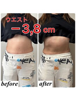 ハリシカ鍼灸院/なんと1回の施術で-3.8cm