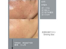 ハーブピーリング/フェイシャル/シミ/ニキビ/毛穴/くすみ/リセラ