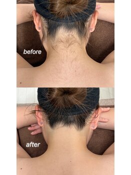 スマイルネイル(SMILE NAIL)/うなじ&背中脱毛