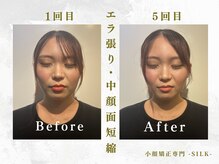 シルク(SILK)/エラ張り・中顔面短縮