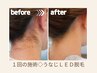 【SNSで話題☆うなじ矯正脱毛】担当マイ◇LED脱毛¥5,500