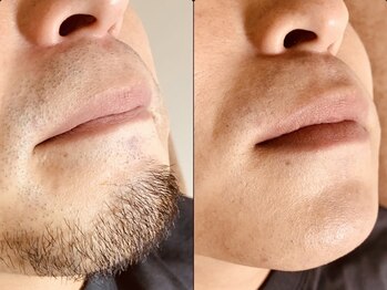 アンドエス 六本木(and S.)/メンズヒゲ脱毛≪六本木髭脱毛≫