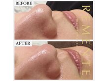 リメンテ 新栄店(REMENTE)の雰囲気（大人気ハイドラフェイシャル☆☆）
