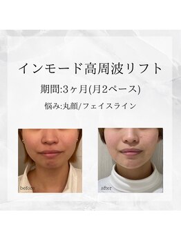 メディカルエステ 東銀座店/業界初インモード高周波リフト 