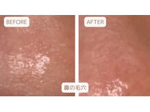 ブーケ/毛穴の汚れ落とします！