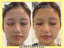 ヴィオール 名古屋栄店(VIOR)/レモンボトル　塗布直後