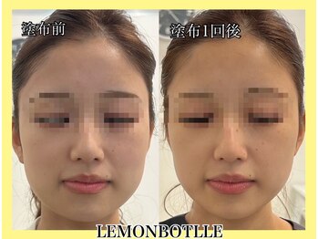 ヴィオール 名古屋栄店(VIOR)/レモンボトル　塗布直後