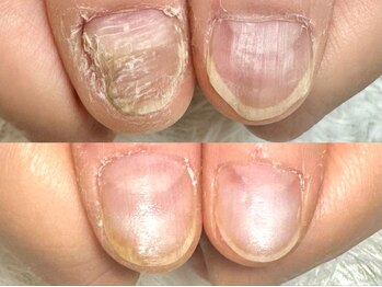 グラシナ なんば店/深爪/自爪育成/フィルイン