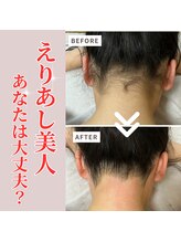 アルエット(Alouette)/うなじ脱毛before/after