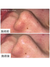 サラン スキンサロン(Sarang skin salon)/川西｜いちご鼻 毛穴改善