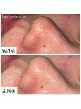 サラン スキンサロン(Sarang skin salon)/川西｜いちご鼻 毛穴改善