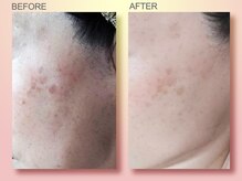 ジュリア オージェ 四条河原町店/ ビフォーアフター（シミケアP）