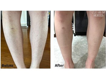 セラス(CERAS)/男性の足脱毛