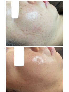 ティエラ(TIERRA)/シミケア19回