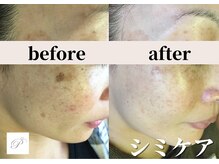 パールホワイトニング/輪郭のあるシミ改善◎