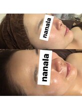 ナナラ(nanala)/韓国水光肌フルコースエステ