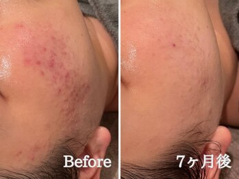 ポポラス(POPOLUS)/ニキビケア　7ヶ月