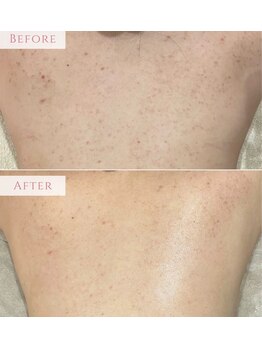 アンドニューリー(&NEWLY)/背中 Before After