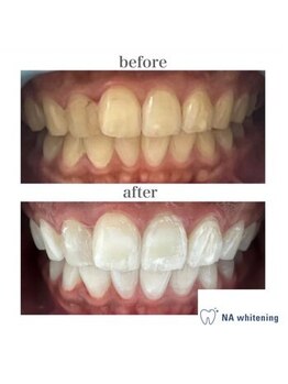 NAホワイトニング 自由が丘店/【before/after】