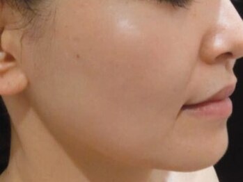 カナウ produced by きょうわ整体院(Kanau.)の写真/【新メニュー導入◇ピーリング＋幹細胞導入2回（2か月ホームケア付き）】肌質を根本から改善◎