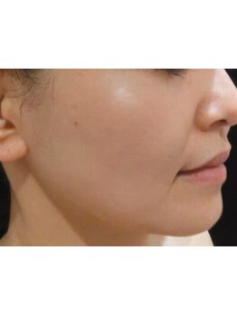 シミしわ改善！予防ケア