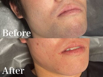 ボス 岡崎店(BOSS)/【顔脱毛/ヒゲ脱毛】あご　#脱毛