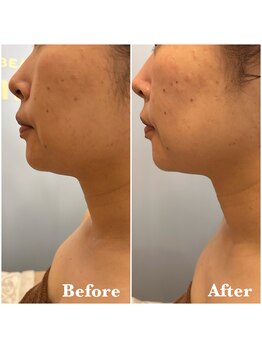 ヴィアージュ(Viage)/レモンボトル