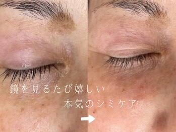 サロンドシエル カスガイ(Salon de Ciel kasugai)/本気のシミケア