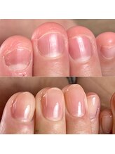 プライベートネイルサロン ケイト(Kate)/深爪の変化