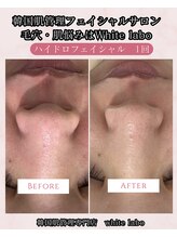 ホワイトラボ 梅田(White labo)/【施術例】ハイドロフェイシャル