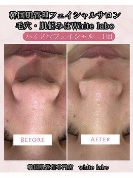 ホワイトラボ 梅田(White labo)/【施術例】ハイドロフェイシャル