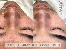 ディレイア ザ コスメ 有楽町マルイ店(direia the cosme)/毛穴黒ずみ/メンズ［有楽町］