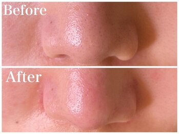 フォルトゥーナ(fortuna)/ハイドロスプラッシュ~毛穴洗浄~