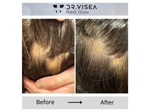 グレースインク ワクシング(GRACE.inc.waxing)の雰囲気（NEW!!【最新のAGAケア導入☆】生え際・頭頂部にお悩みの方必見！）