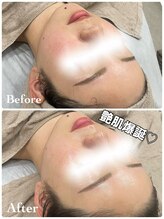 ミレーヴ(MiReve)/毛穴・ブライダル